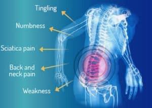 How To Get a Slipped Disc Back In Place.