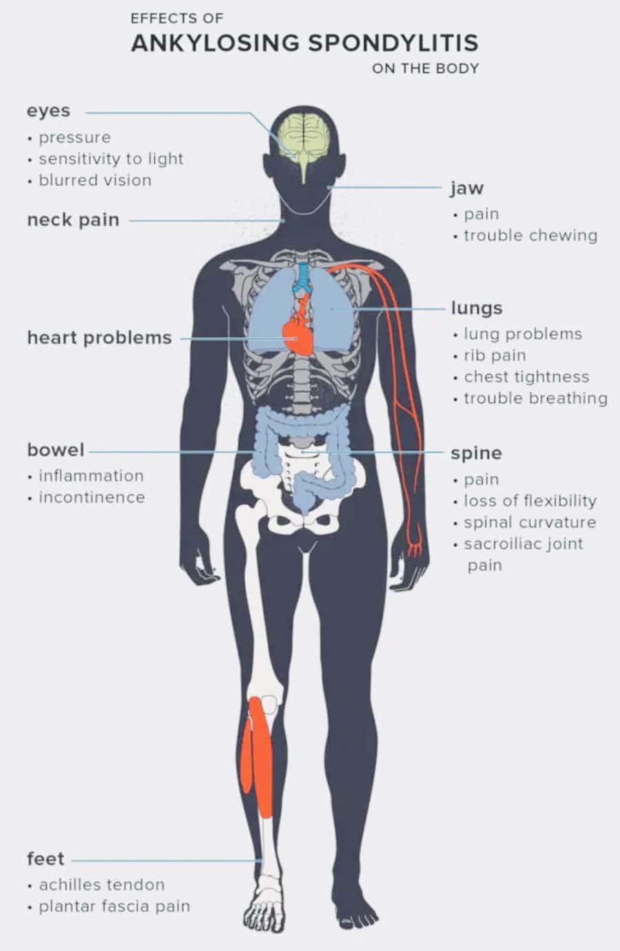 Ankylosing Spondylitis On The NHS And How We Treat It.