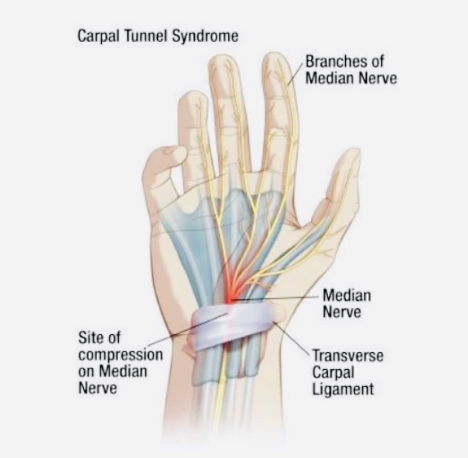 Carpal Tunnel Syndrome On The NHS