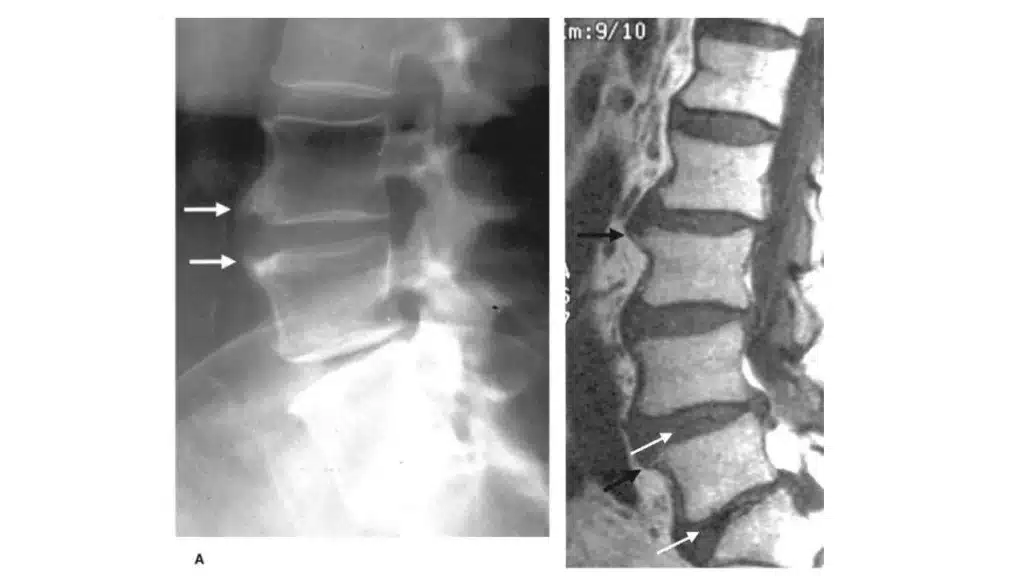 posture compensation using the posture analysis scan